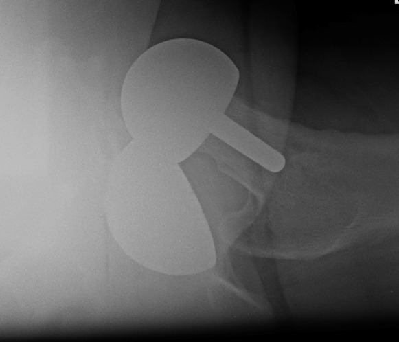 Dislocated Birmingham Hip Resurfacing